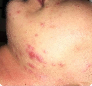 acne-before